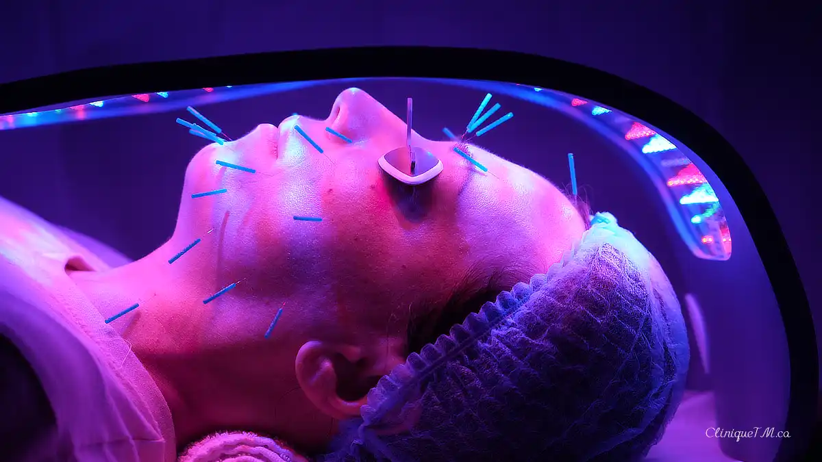 Facial cosmetic acupuncture