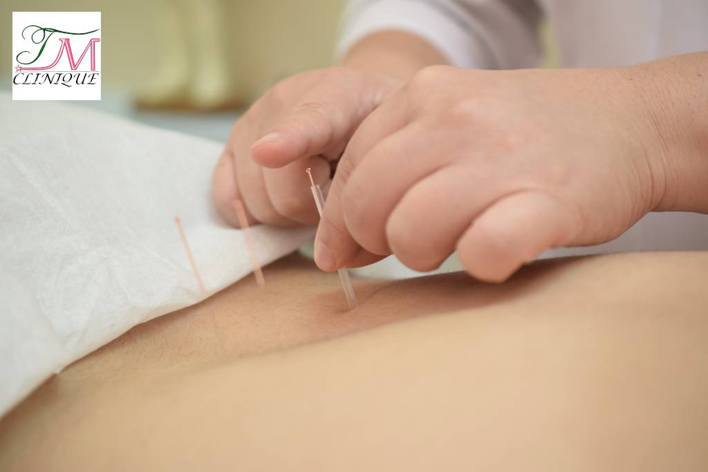acupuncture longueuil