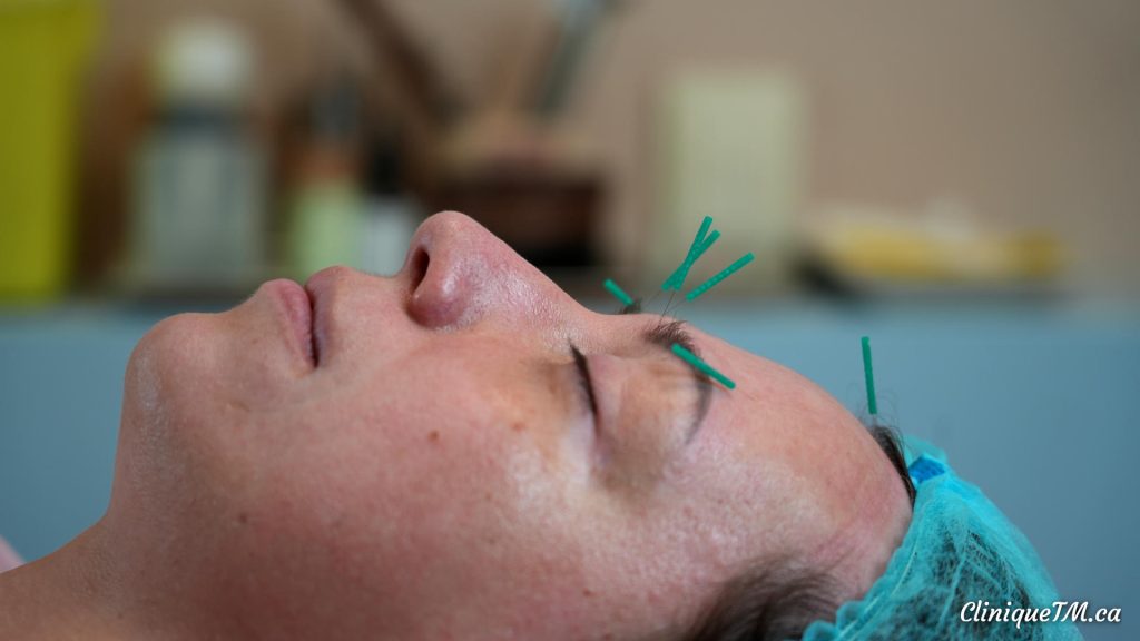 Acupuncture esthétique faciale Longueuil